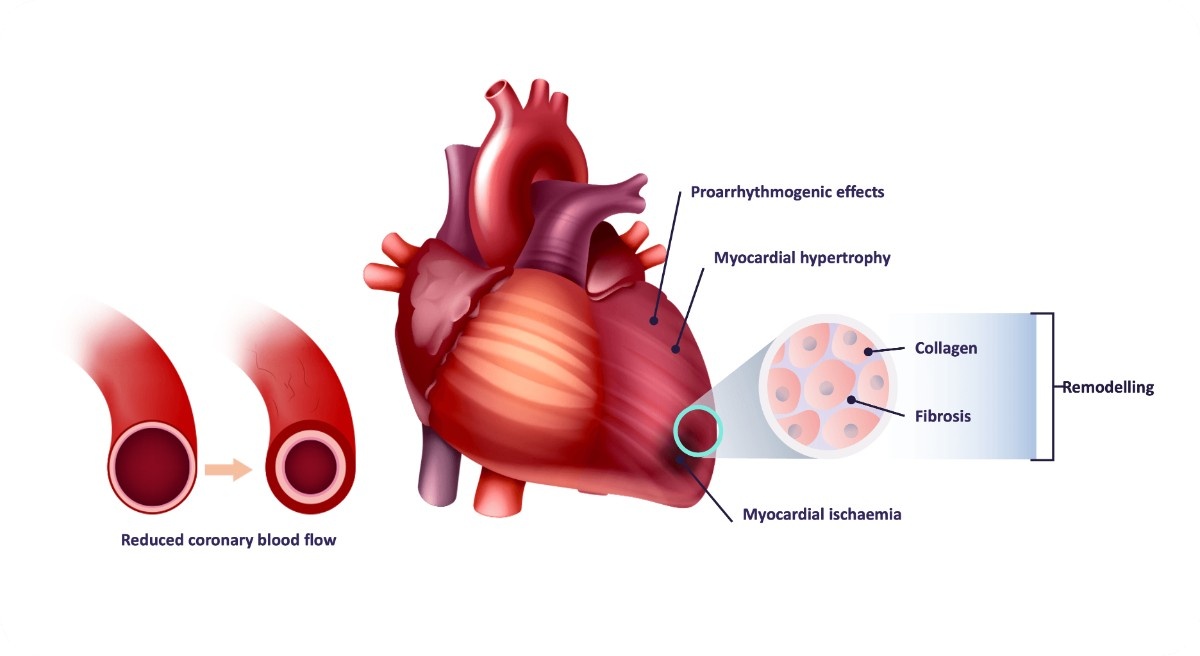 Elevated Levels of Aldosterone-Mediated Effects on the Heart Infographic