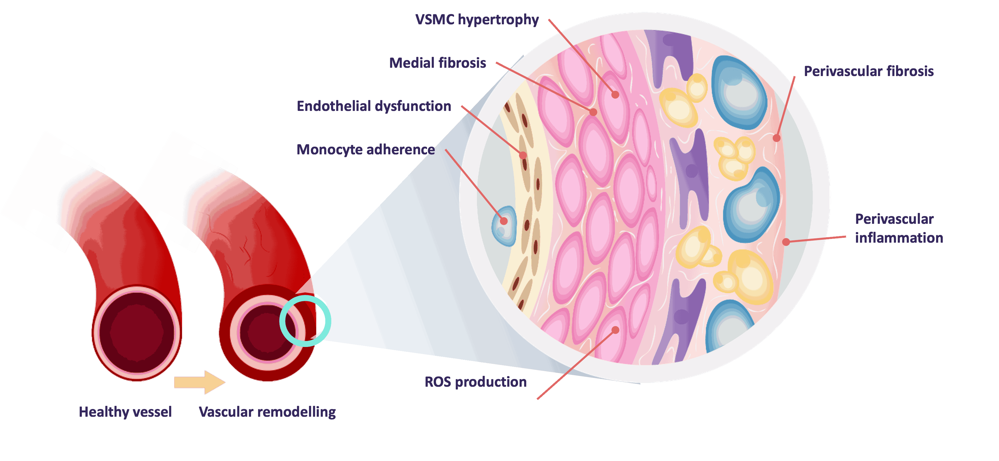 Elevated Levels of Aldosterone and Vascular Injury Infographic